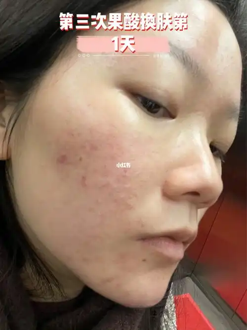 第三次果酸换肤第1天 谢红付 天马雅肤_换肤_果酸_维a_水果_谢红付_美