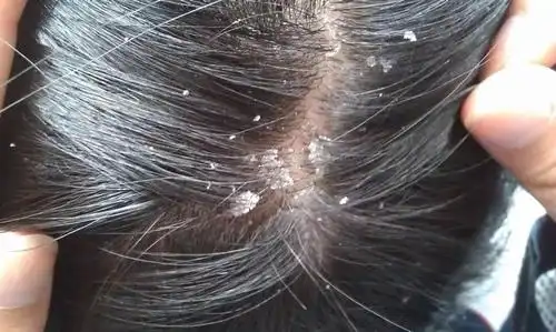 头皮问题图文对照