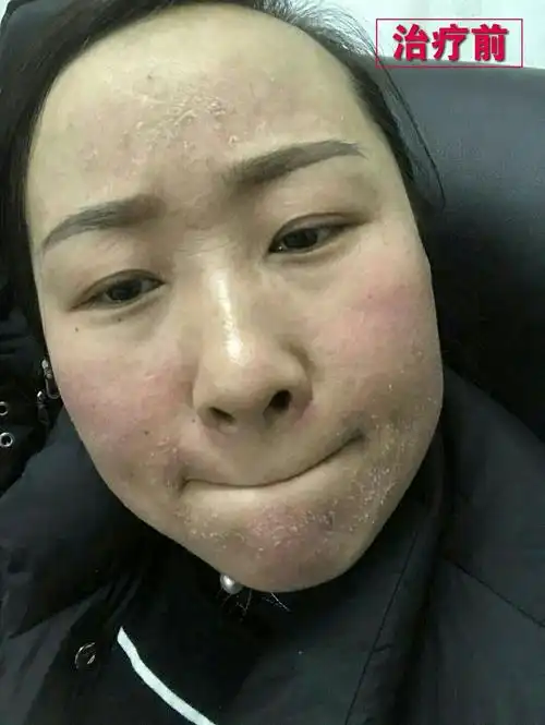 皮肤过敏变美的经历 - 美篇