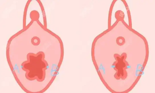 3d生物束带紧缩术部位