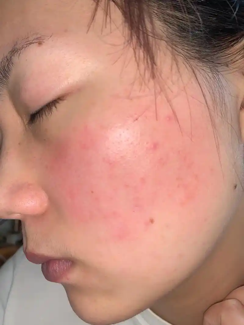 去了趟皮肤科我悟了,原来去红血丝这么简单.06别问,问就是红 - 抖音