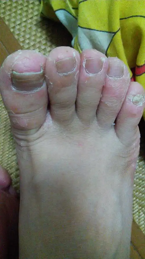 [小夫妻]哺乳期又不能用药,这脚,丑死了,也愁死了～夏天都不敢穿凉鞋