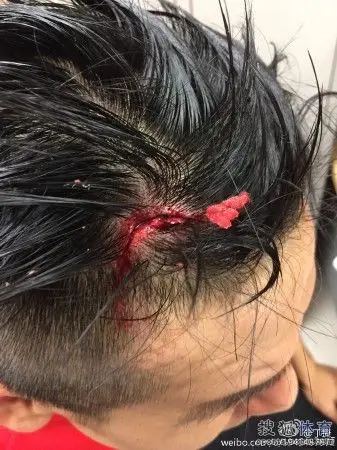 力帆大将头皮缝针伤口恐怖 微笑留影报平安(图)