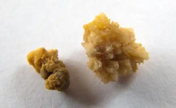 体内尿酸高,这3个部位最容易被伤害,痛风是情况最轻的