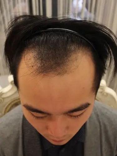 7615大麦微针植发-06术前情况发友m型脱发的面积是比_圈子-新氧