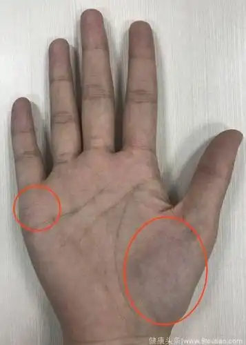 如果大鱼际发青,有宫寒的情况,而你却不痛经,说明你的身体,比痛经的