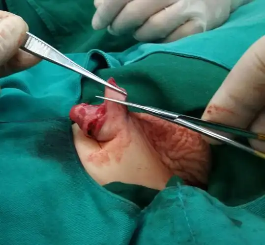 隐匿阴茎矫形术(f法)