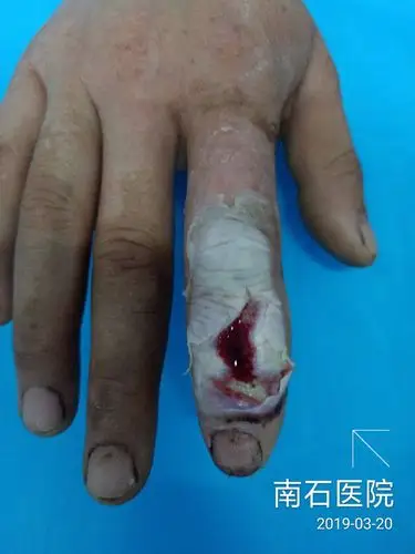手指外伤合并高压油泵冲击形成窦道伤治疗经验总结汇报糸列之二十七急
