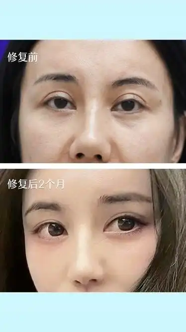 你做的双眼皮为什么显老看看40岁的她双眼皮修复效果给你答案