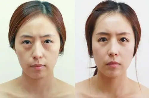 干细胞皮肤再生术对比案例