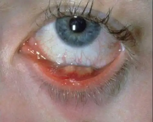 针眼是什么,怎么处理?-春雨医生