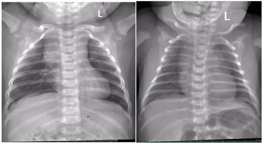 这几组患儿胸片是肺炎还是正常影像规培医师懵了