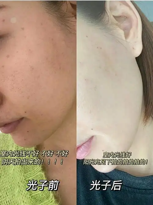 光子嫩肤对比绝对美白
