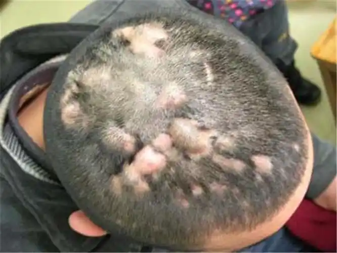 男童头皮毛囊炎康复图片_有来医生
