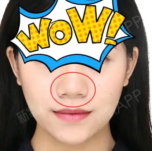 我的鼻梁比较高就是鼻头肉多鼻翼肥厚可以不垫假体直接改善鼻头和鼻翼