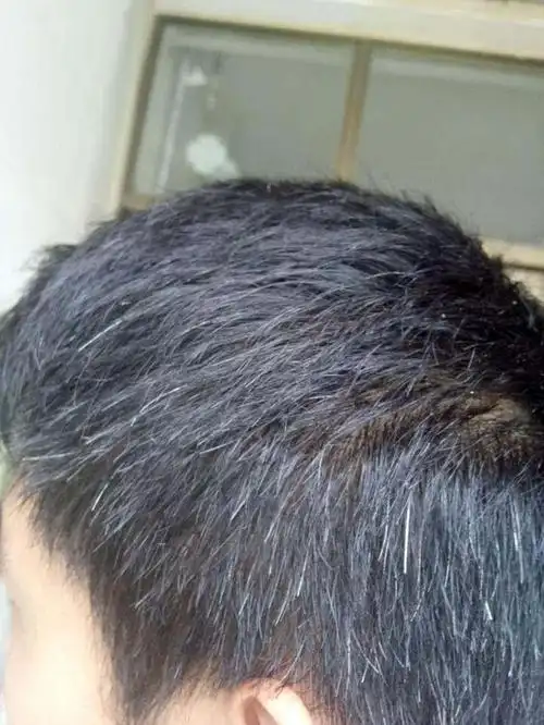 儿童白发如何治疗偏方_治疗白发的偏方_治疗白发脱发的偏方