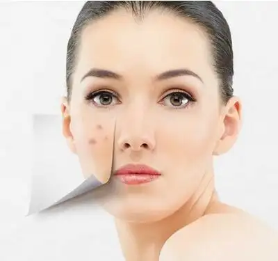 祛痘痘最有效的方法 史上最有效祛痘痘方法盘点