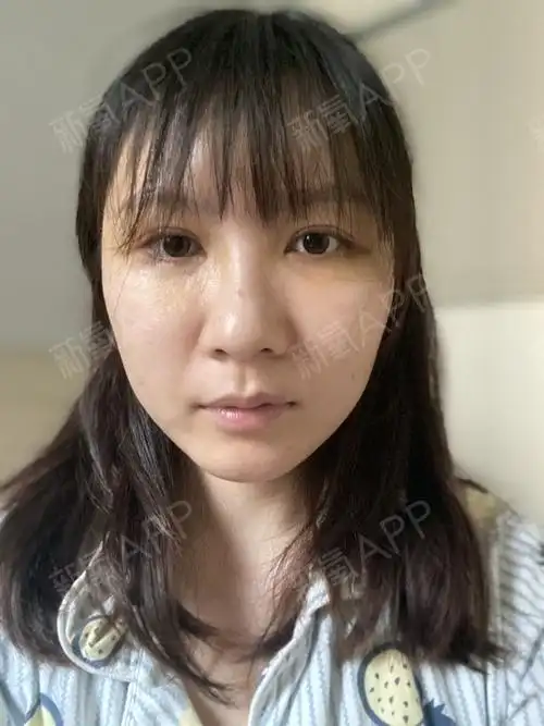 今天是做完全脸脂肪填充术后的第七天,我做的项目比较_圈子-新氧美容