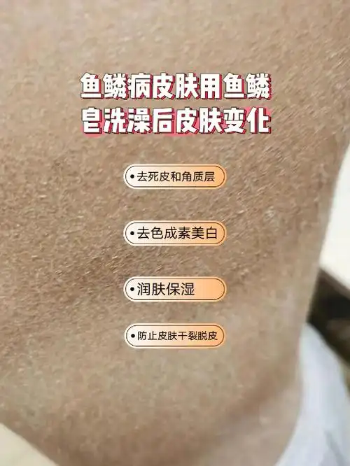 鱼鳞病皮肤用鱼鳞皂洗澡后的皮肤变化