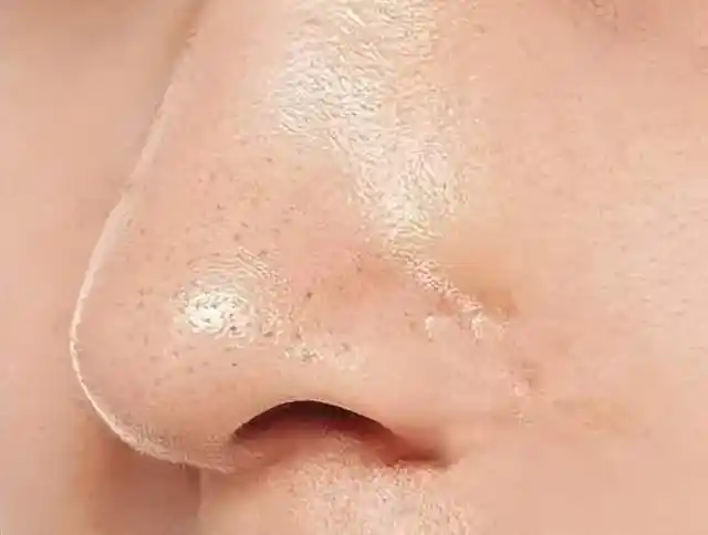 所以清洁黑头,主要在于清洁毛孔,控油.