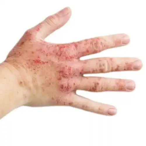 过敏性皮炎种类多别乱用药