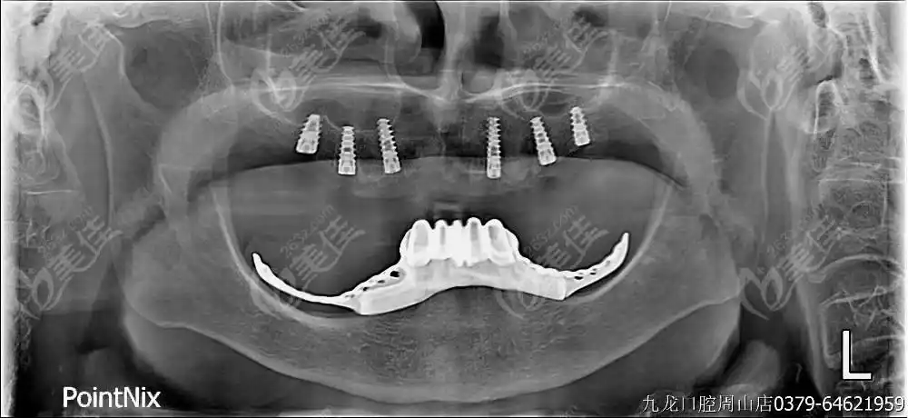 洛阳九龙口腔种植牙技术怎么样光看周山路郑淑敏院长的这个半口种牙