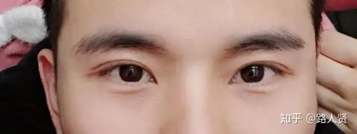 男生双眼皮实时更新分享全切双侧提肌及一些个人想法