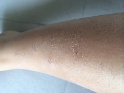 13 2014-02-20 小腿皮肤长癣 2007-09-10 救救我……我小腿上长满