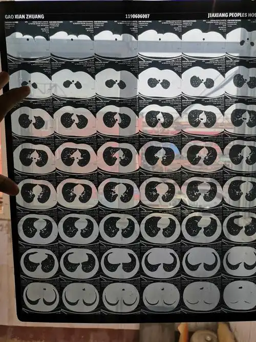 6月6号在医院做的胸部平扫ct 我这是肺气肿吗?