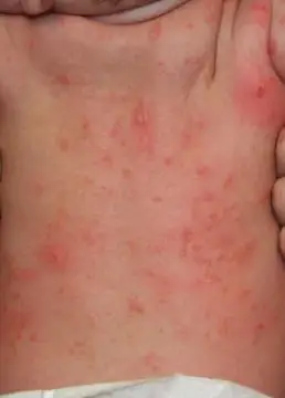 杭州市儿童医院 万明顺 婴幼儿疥疮临床特征及鉴别诊断