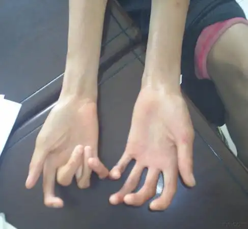 第一次亲眼见到,患者在武汉协和已经确诊为马凡氏综合症