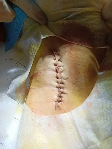 腋臭微创刮吸术——腋臭患者的福音