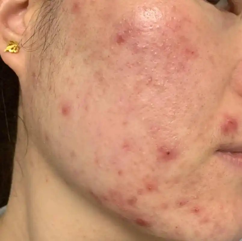 激素脸 #敏感肌 #问题性皮肤管理 #痘痘肌 有豆豆的你为 - 抖音