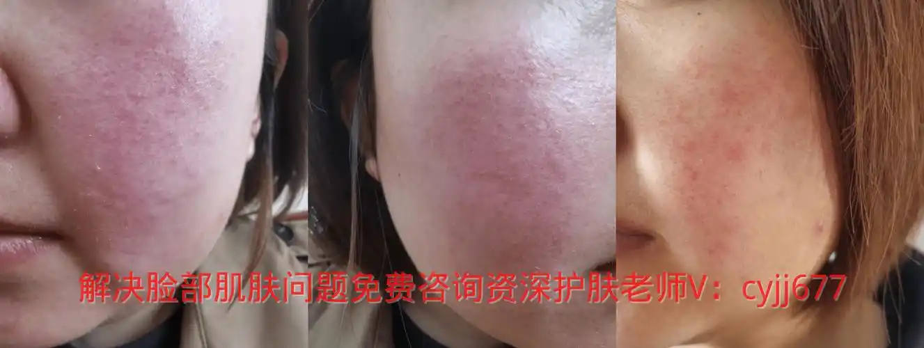 皮肤屏障受损有红血丝怎么修复皮肤屏障受损出现红血丝需要多久自愈