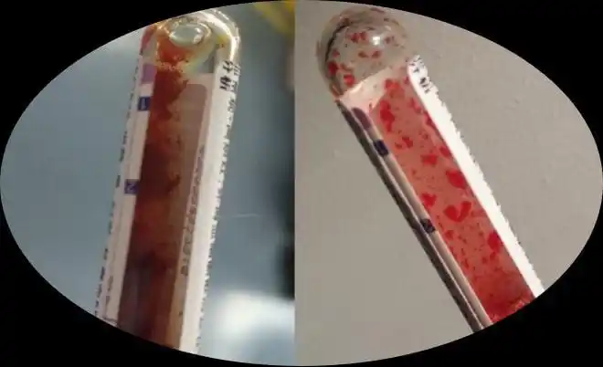 一例红细胞冷凝集导致血常规计数偏差