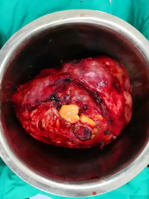 腹腔平滑肌肉瘤病例分享