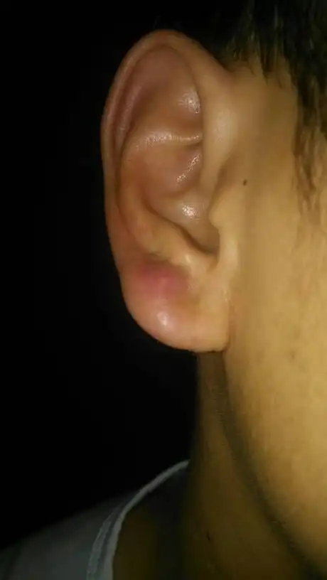 耳垂中间长了一个疙瘩,每年都会反复发作一两次周期都不长一个星期