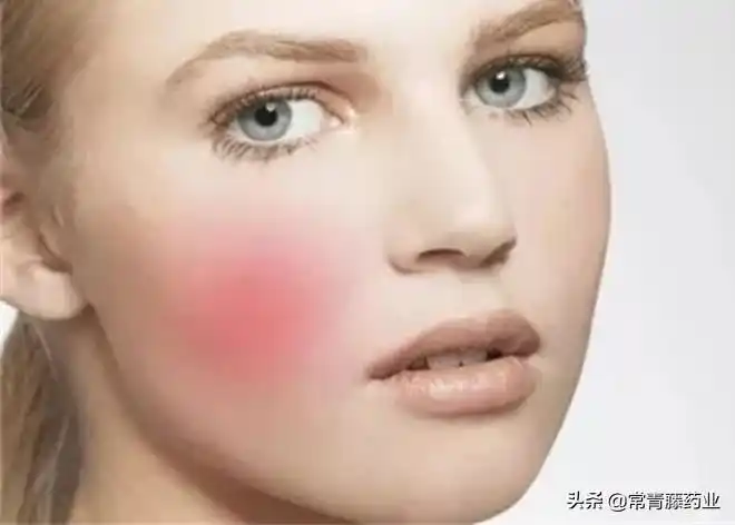 脸蛋容易泛红,可能不是羞涩,皮肤科医生:真相可能是玫瑰痤疮