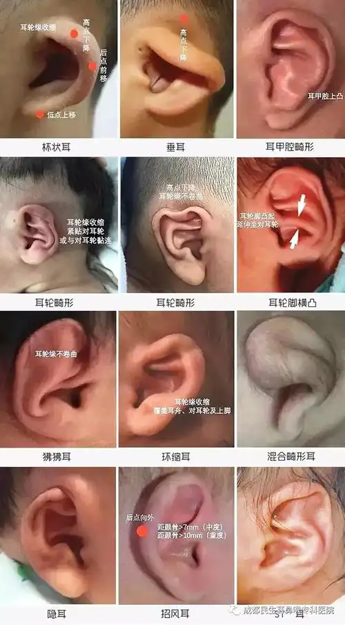 成都民生耳鼻喉专科医院矫正宝宝耳朵畸形怎么样