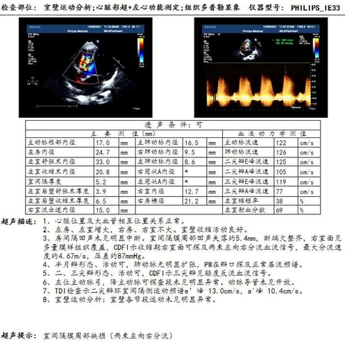 右腋下小切口治疗室间隔缺损