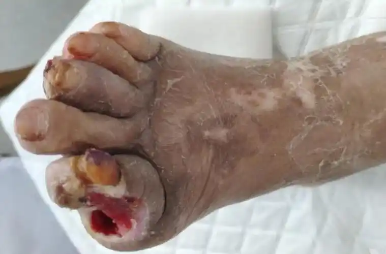 严重感染的糖尿病足险遭截肢最后一个足趾都不少这样处理最有效