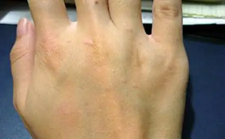 五种不同类型的扁平疣症状特点是什么