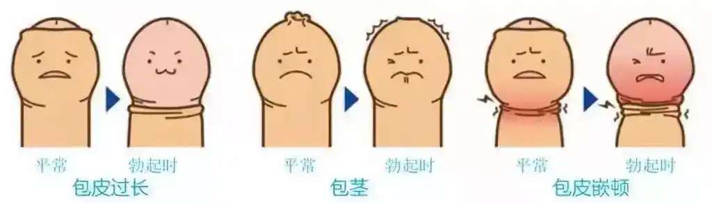 基本正常,包皮切除术后一般一周左右可拆线,你的情况恢复尚佳,应该