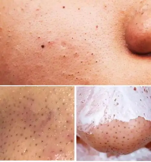 saの私享喷喷它黑头油脂自动脱落和毛孔污垢说再见