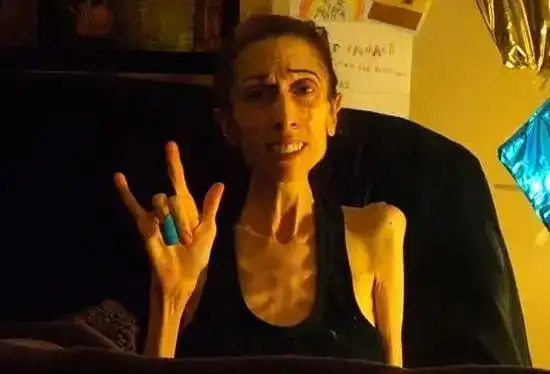 一个如花似玉的大姑娘,因为极端的减肥方法,瘦成了皮包骨,厌食,催吐