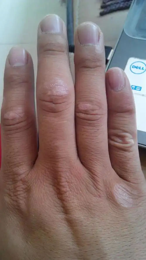 在手指的关节处有红色的癣状,时间有3-4年了,也去医院差过了,吃药和