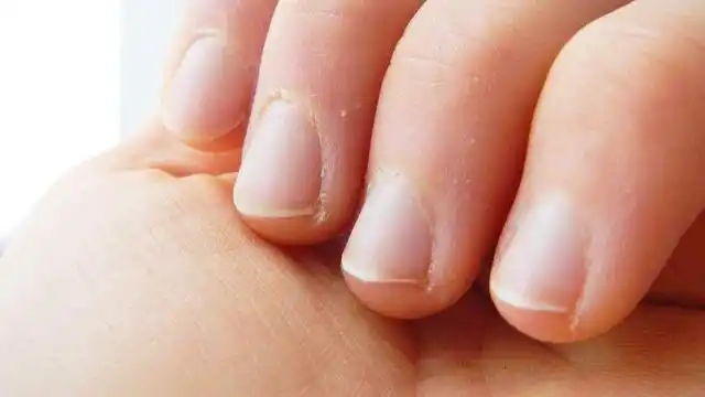 手指甲软怎么办