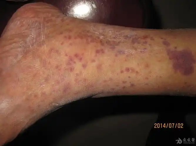 小腿红斑不痛不痒2月这是什么皮肤病过敏性紫癜