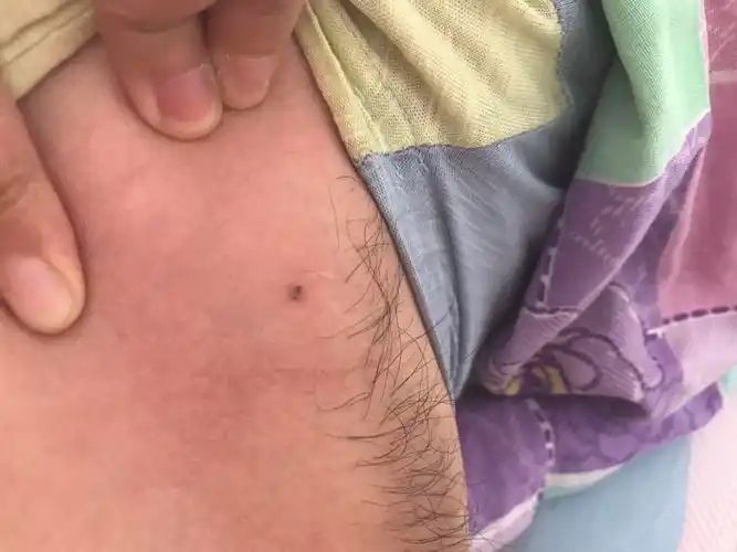 腋下长了个小疙瘩,无感觉,黑色,摸起来感觉跟脸上得痘痘一样,跟小