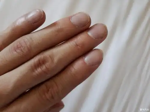(早起之后手指盖微微发紫)